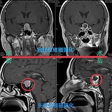 院内首例单鼻孔入路经蝶垂体腺瘤切除术顺利完成