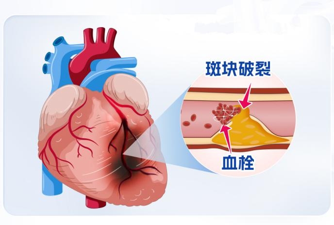 掌控人生压力值，别让心脏负重前行！