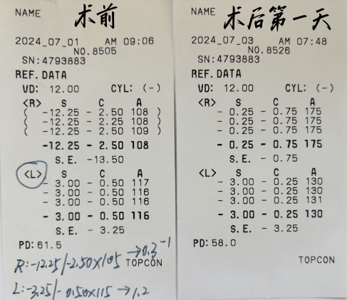 【青岛早报】视力从0.02到1.0，青滨附院眼科一次手术解决三大问题