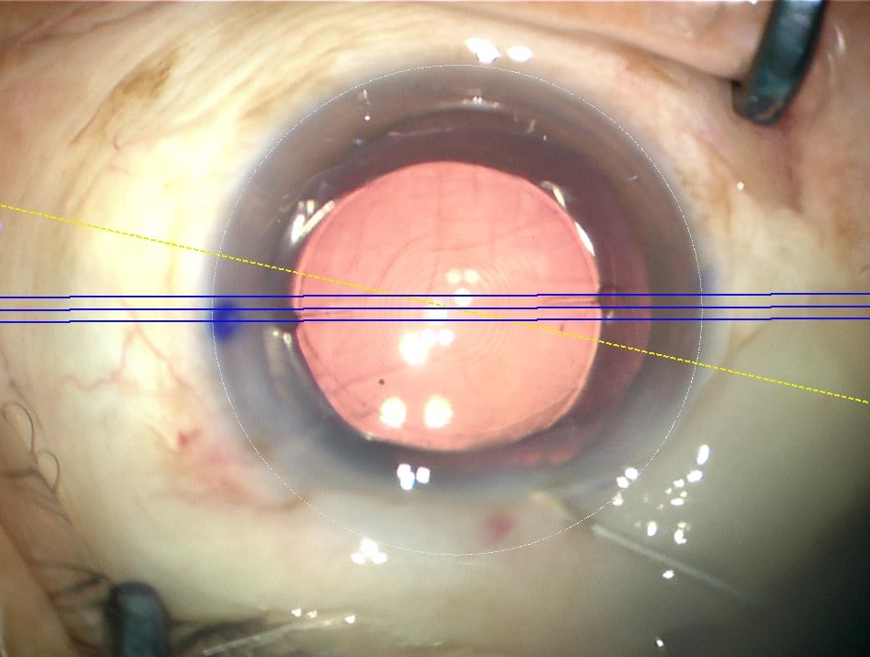Callisto Eye导航系统，开启白内障精准治疗时代