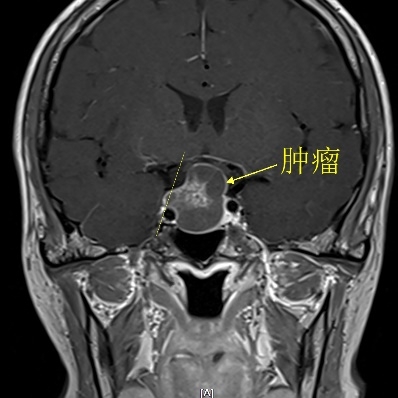 “双镜”联合！微创切除患者巨大侵袭性垂体腺瘤